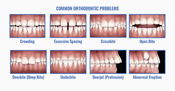 Common Teeth Issues